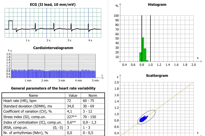 Ausschnitt einer HRV-Auswertung mit EKG-Ableitung, Kardiointervallogramm und Histogramm